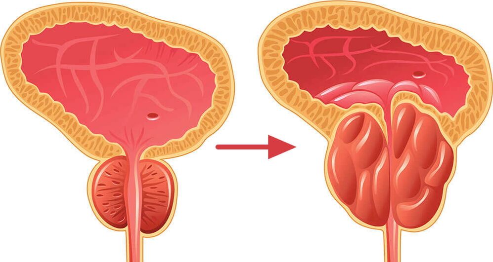 Prostata - normalna in vneta