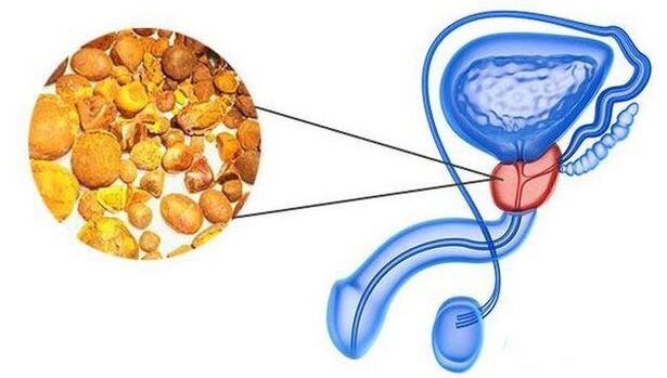 Kalcini v prostati