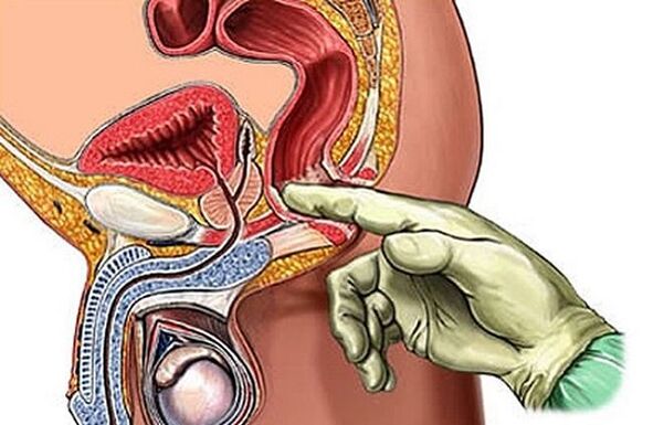 Masaža prostate kot način zdravljenja prostatitisa