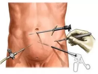 kirurško zdravljenje kroničnega prostatitisa