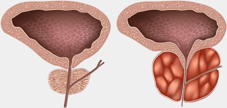 zdrava in vneta prostata s prostatitisom