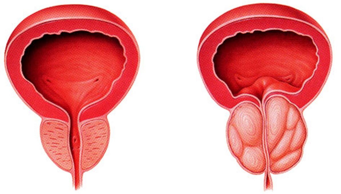 zdrava in vneta prostata s prostatitisom