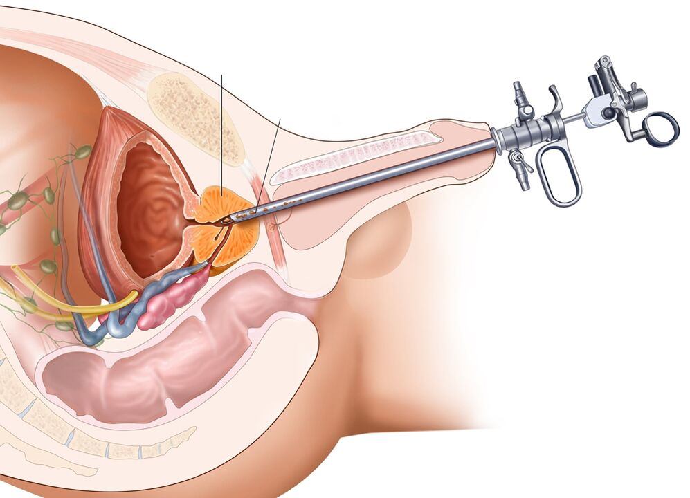 Transuretralna resekcija prostate vam omogoča odstranitev prizadetih delov organa