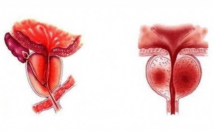 Akutno vnetje prostate, ki lahko postane kronično